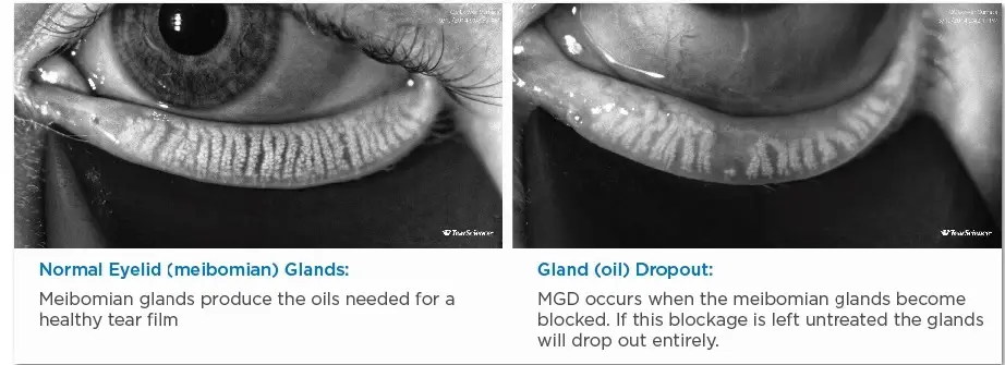 Meibomian Gland Dysfunction MGD dry eye ptosis cause for dry eye IPL Therapy Alpharetta