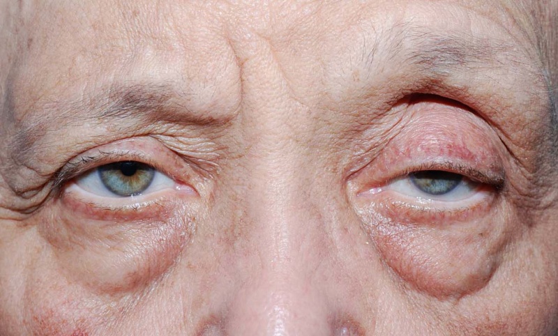 ptosis cause for dry eye IPL Therapy Alpharetta